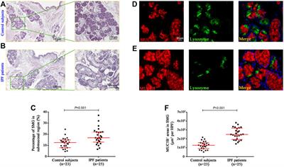 Mucus Hypersecretion and Ciliary Impairment in Conducting Airway Contribute to Alveolar Mucus Plugging in Idiopathic Pulmonary Fibrosis